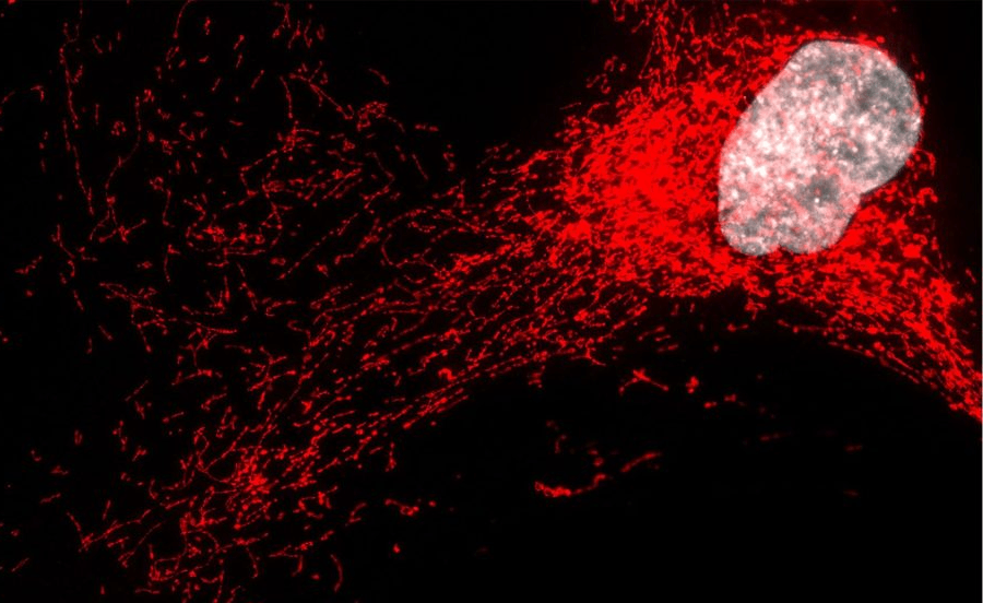‘Zombie’ cells spark inflammation in severe fatty liver disease, Mayo Clinic researchers find